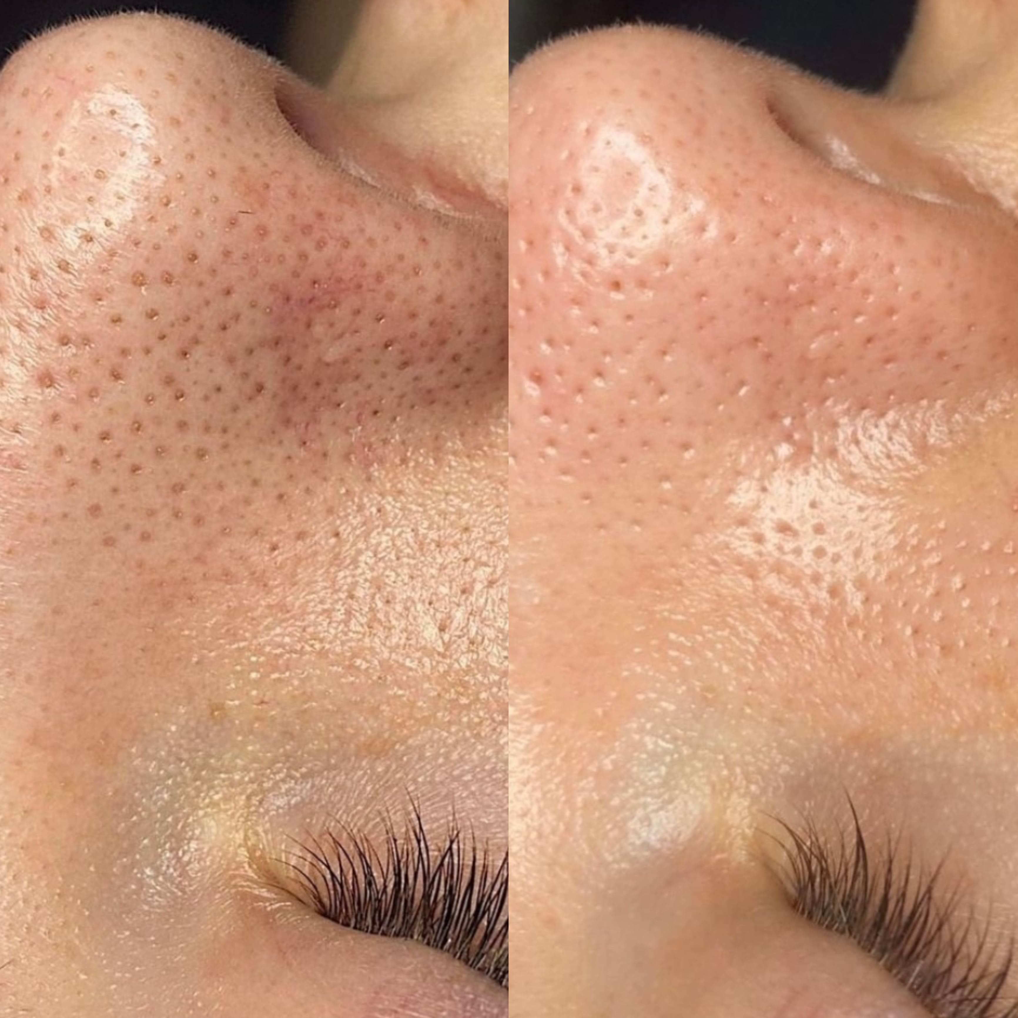 Hydrafacial