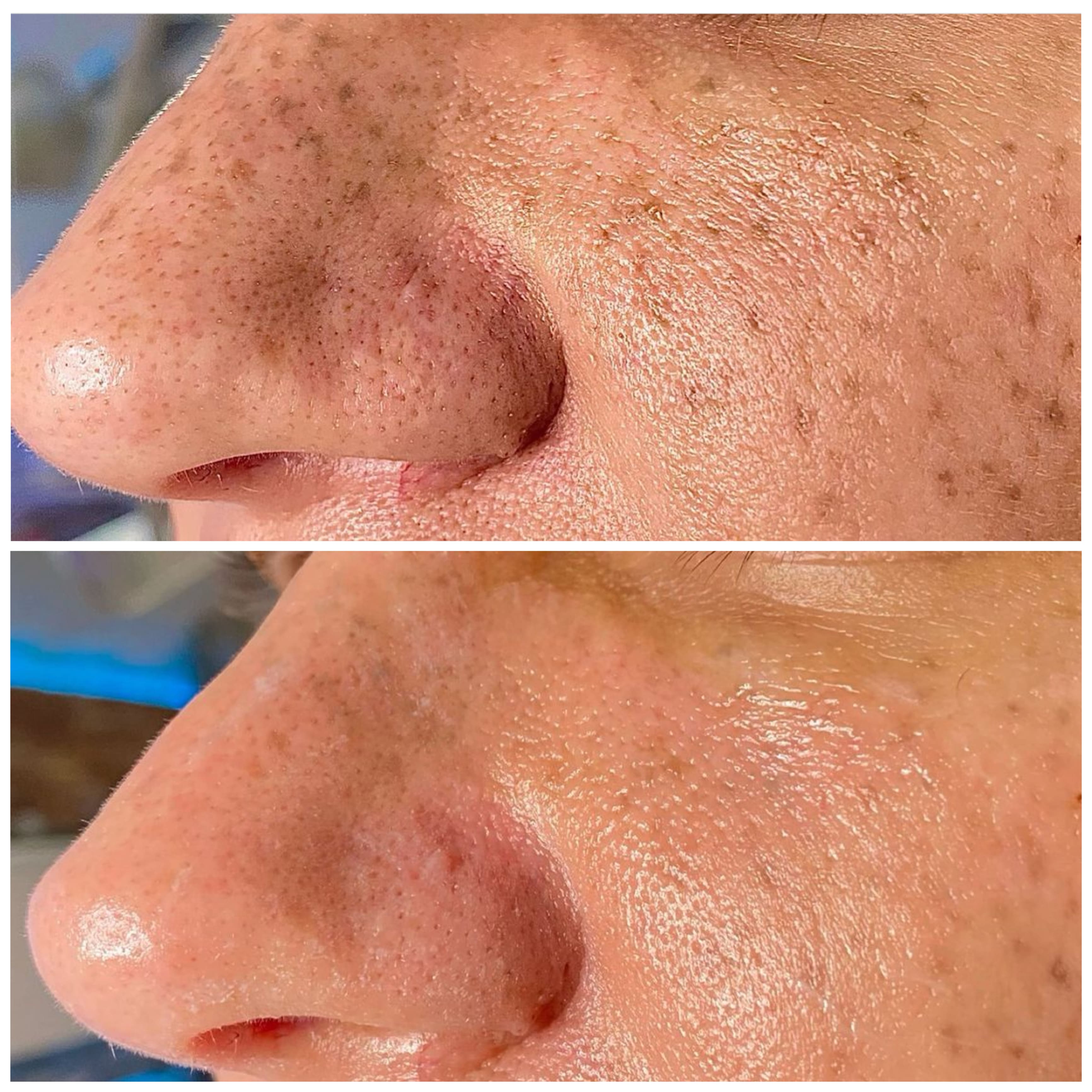 Hydrafacial