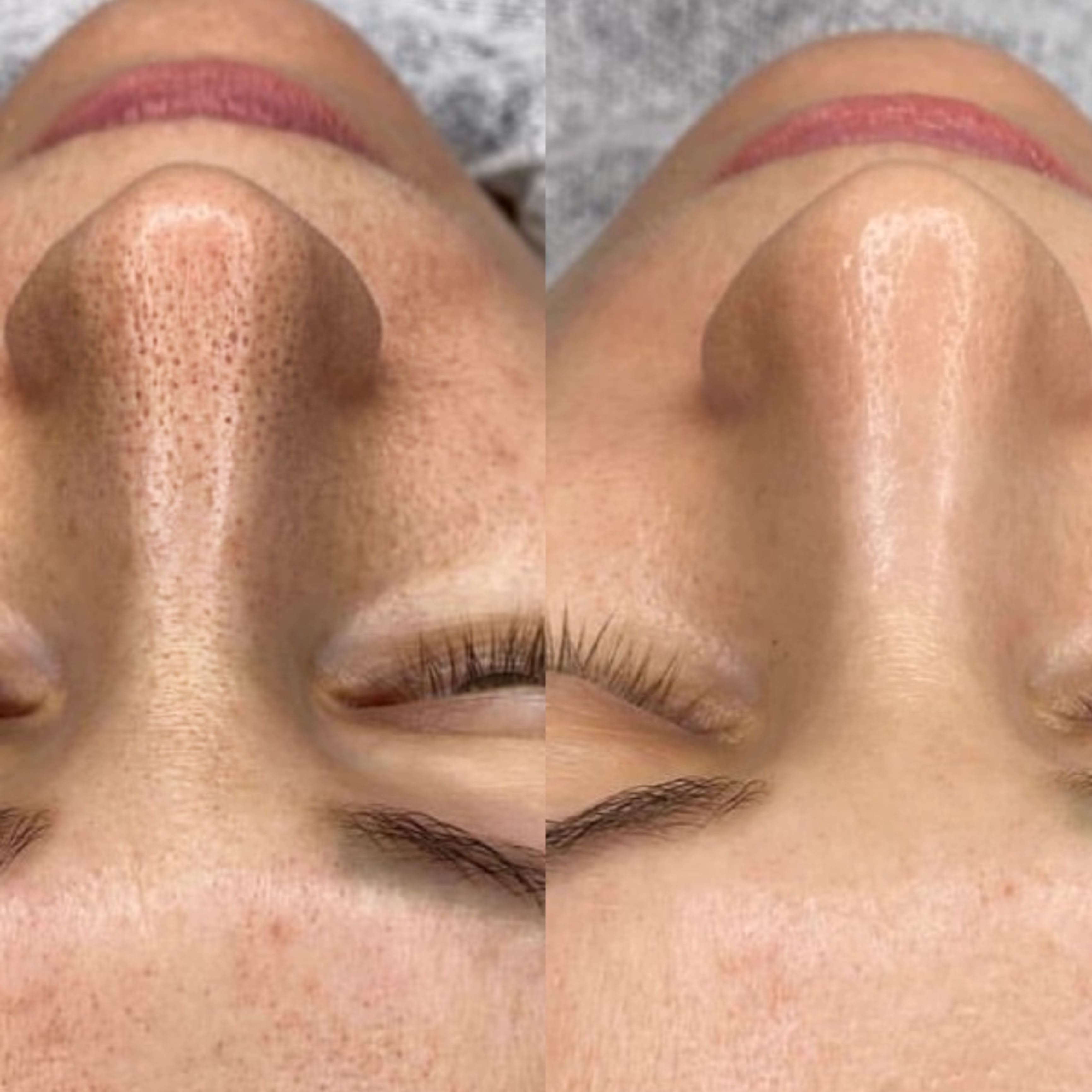 Hydrafacial