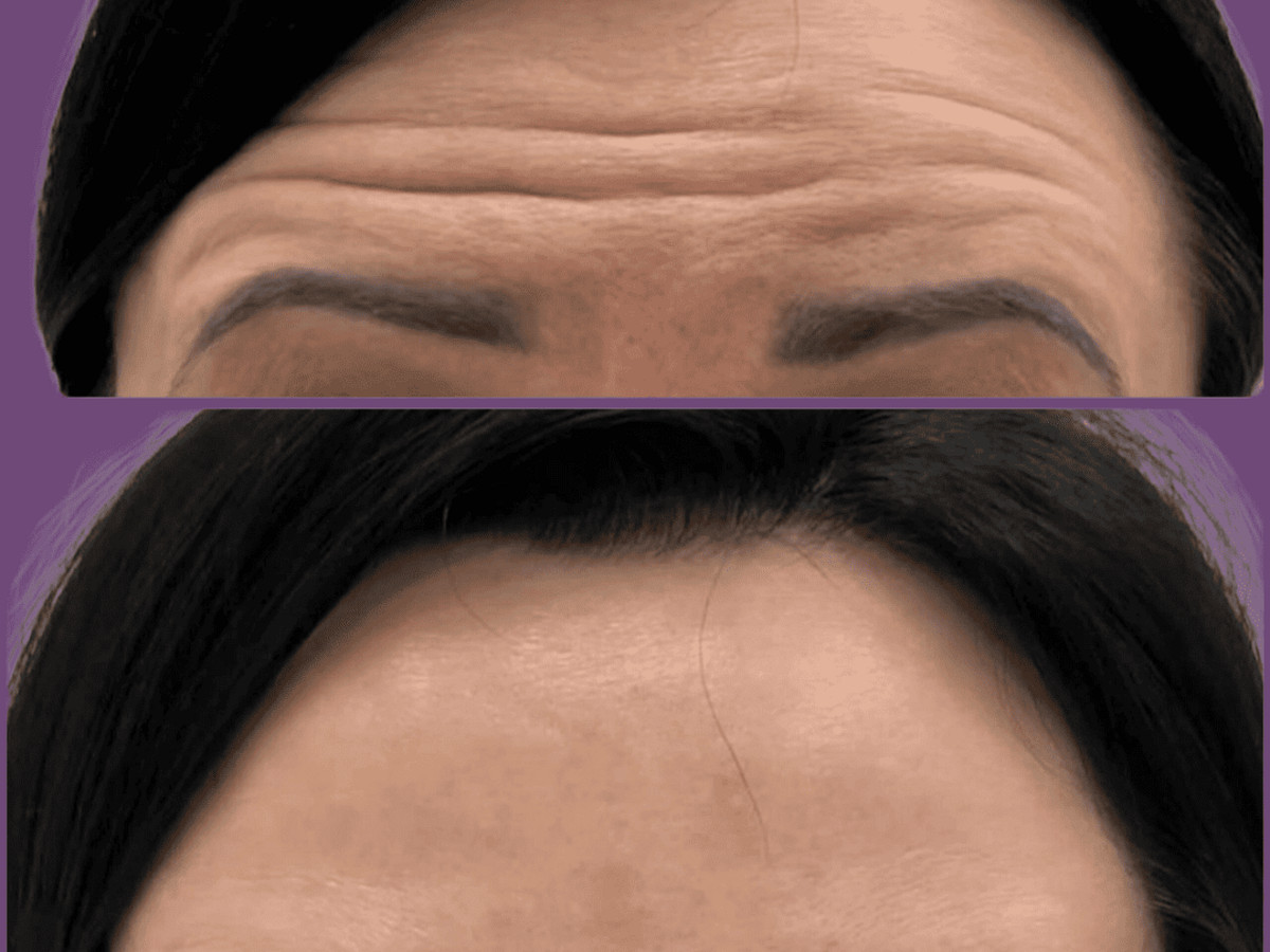 Мимические морщины на лбу