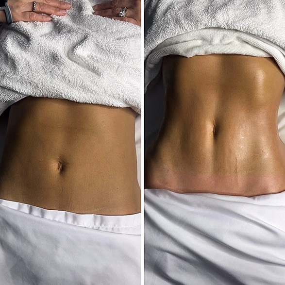 EMSCULPT