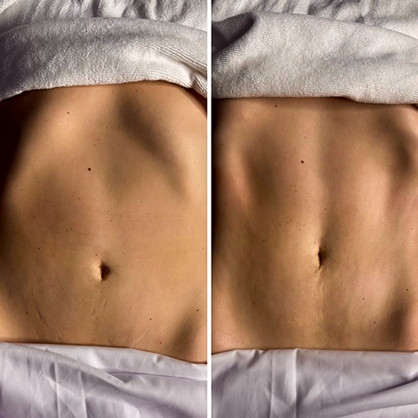 EMSCULPT