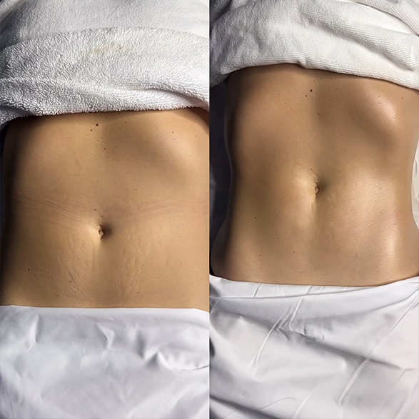 EMSCULPT