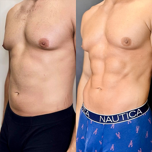 EMSCULPT
