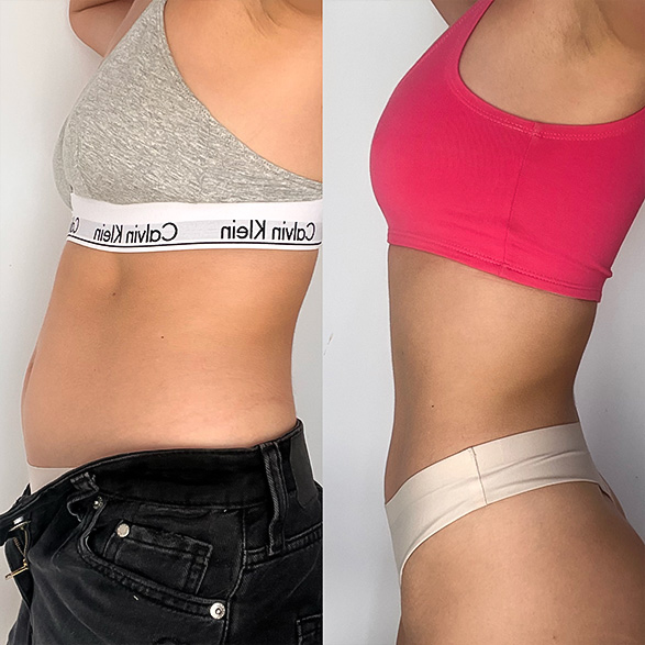 EMSCULPT