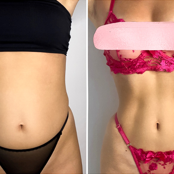 EMSCULPT