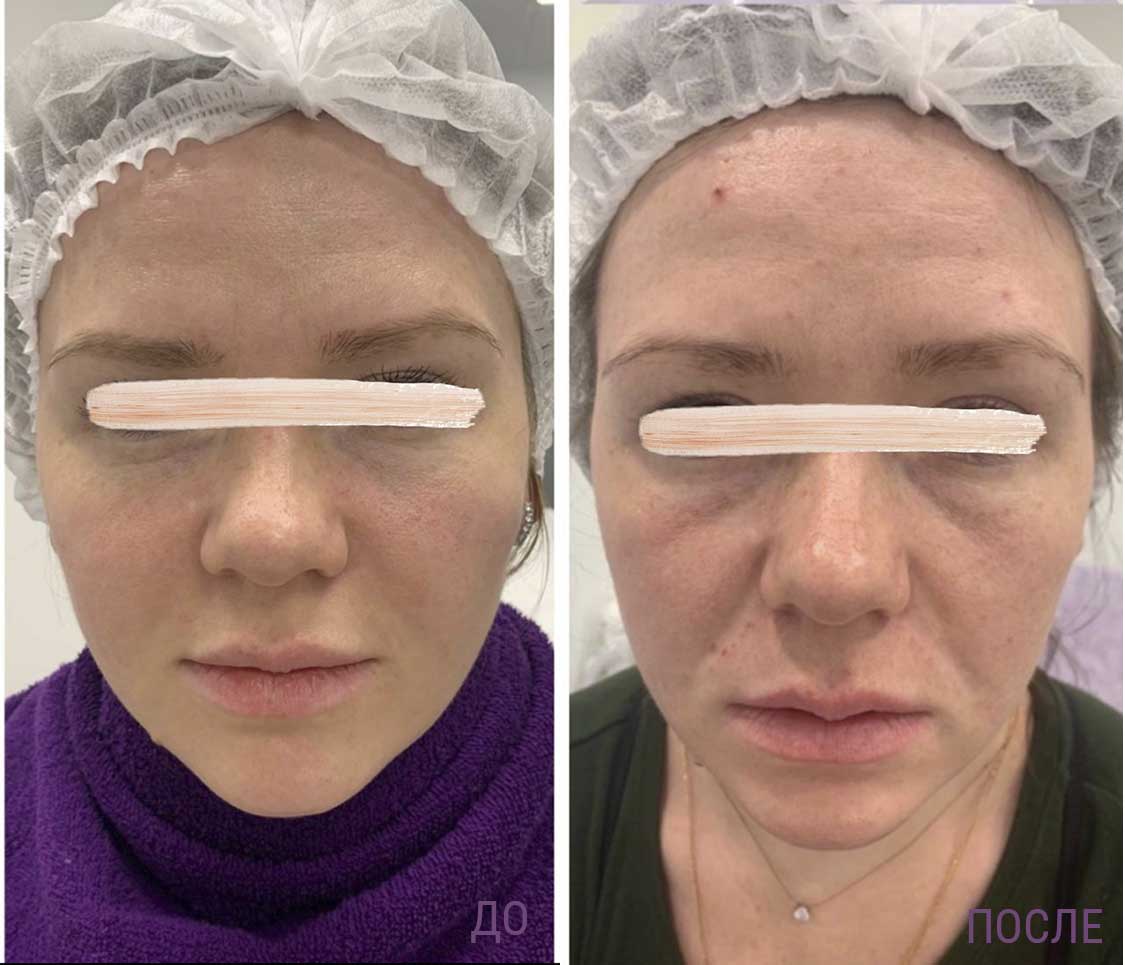 Акция на услугу Full face в клинике Алтеро
